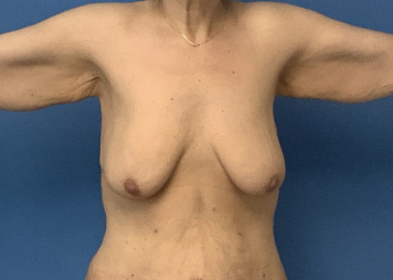 Breast-Augmentation-with-Lift--Case-Study-6152 | Before Breast
